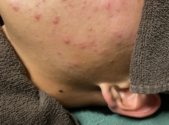 思春期のニキビケアはお任せ‼️