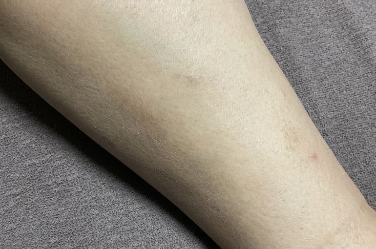 ヒゲやムダ毛は剃るより脱毛‼️