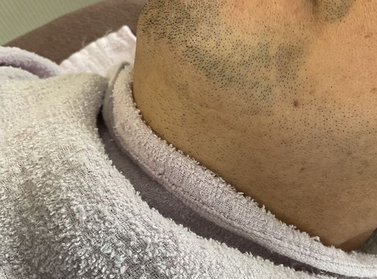 ヒゲ脱毛は1回目が爆抜けのポイント‼️