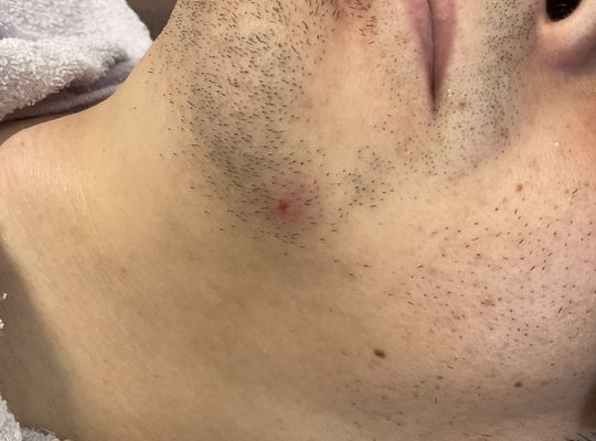 ヒゲを抜いたりしていませんか❓