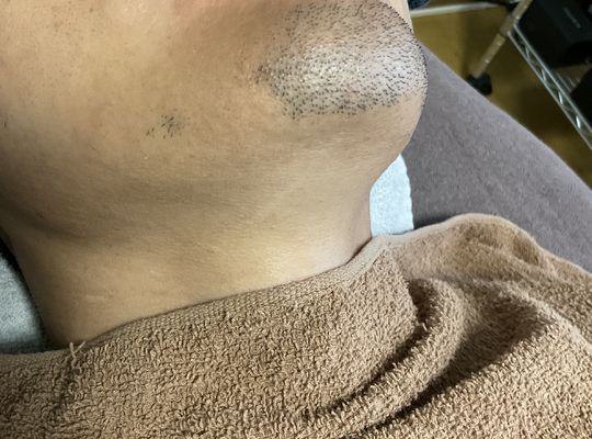 アゴ髭は抜けにくい原因は⁉️