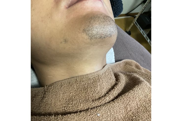 アゴ髭は抜けにくい原因は⁉️