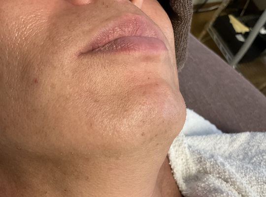 ヒゲは脱毛してもまた生えてくる‼️