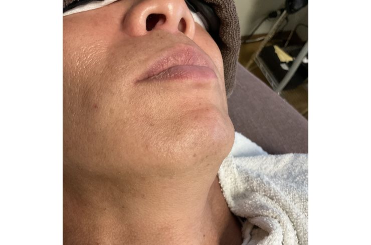 ヒゲは脱毛してもまた生えてくる‼️